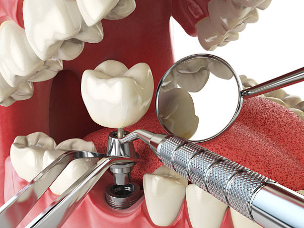 Best Emergency Dentist for Knocked-Out Tooth in Woodbury, NY